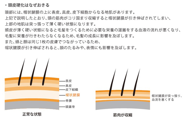 頭皮硬化